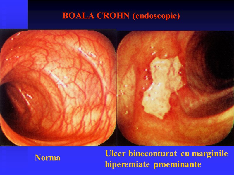 BOALA CROHN (endoscopie) Norma Ulcer bineconturat cu marginile  hiperemiate proeminante